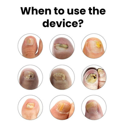 Romena™ — Toenail Fungus Light Therapy Device